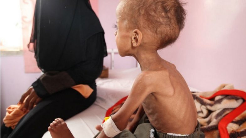 Yemen: 85,000 Kids Dead in Last 3 Years as Their Vital 