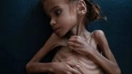 Amal Hussain, Malnourished Yemen Girl Whose Famous Photo Turned World&rsquo;s Eyes to Famine, Is Dead