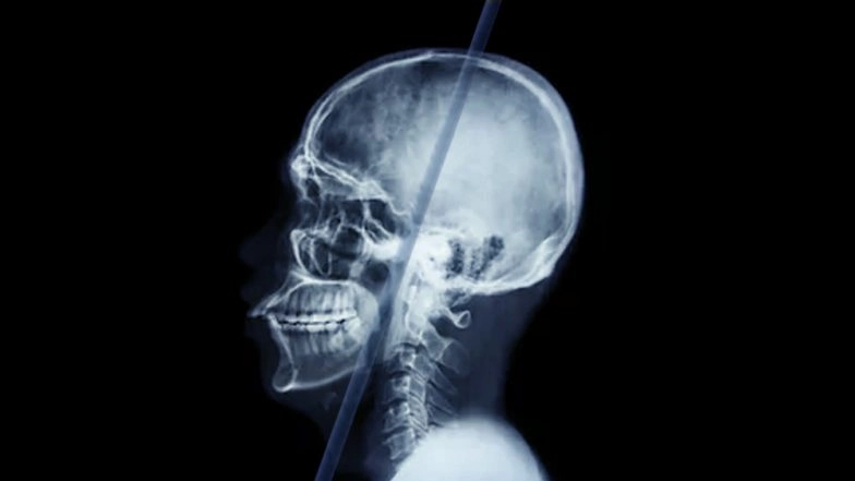 Bone Density Associated with Its Regular Use, Finds Study