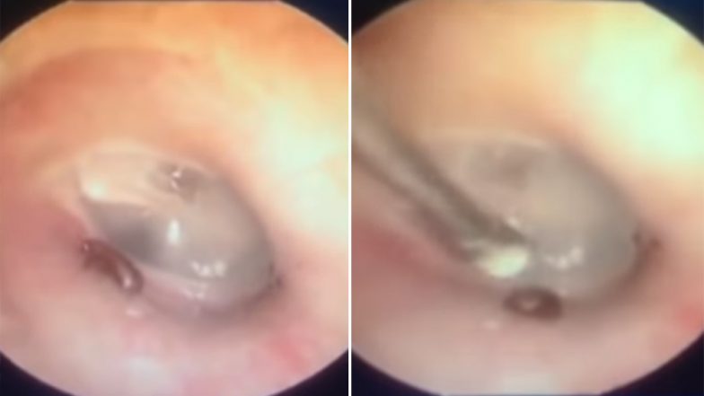 Doctors Removing an Ant From Vietnamese Man’s Ears Will Make Your Stomach Churn (Watch Video)