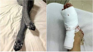 Woman’s ‘Snake Stockings’ Mistaken for Real Snakes, Husband Beats Her with a Baseball Bat (See Pic)