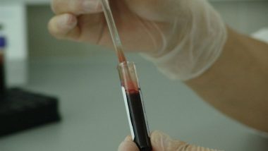 Novel Smartphone App Can Detect Anaemia Without Blood Test
