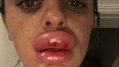 UK Woman’s Lips Balloon Up After Filler Procedure Goes Wrong at ‘Botox Party’