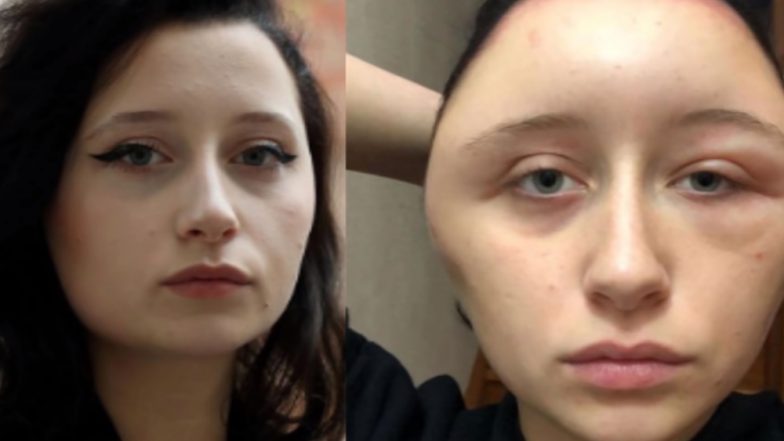 Reaction To PPD in Hair Dye Causes French Woman’s Head To Swell Up, Resembling a Light Bulb