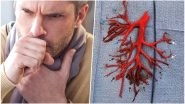 US Man Coughs Up Blood Clot Shaped Like His Lungs! Bizarre Pic Goes Viral