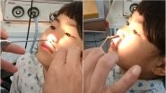 Doctor Removes Three-Inch-Long Live Worm From Six-Year-Old's Nose in Vietnam, Video Goes Viral