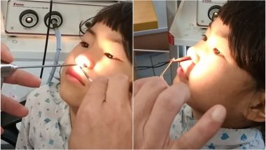 Doctor Removes Three-Inch-Long Live Worm From Six-Year-Old's Nose in Vietnam, Video Goes Viral