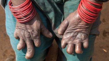 World Leprosy Day 2020: Dealing With the Stigma of the Disfiguring Disease