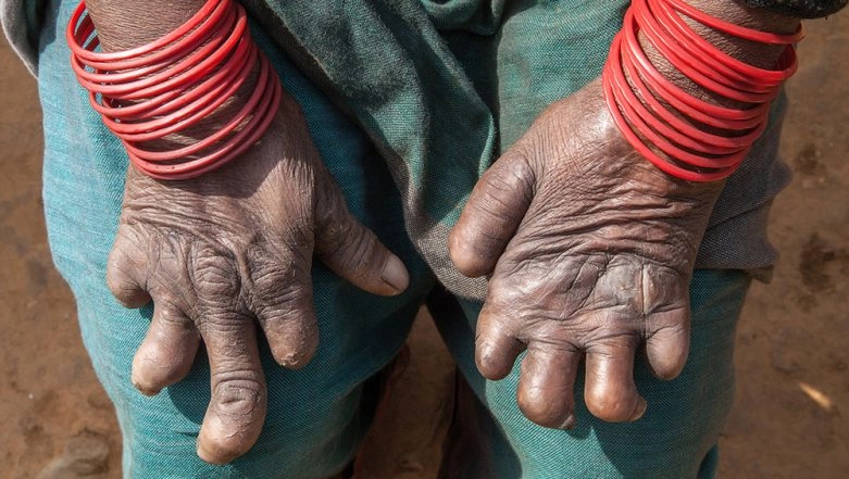 Leprosy Stigma: Busting Myths Surrounding the Disease