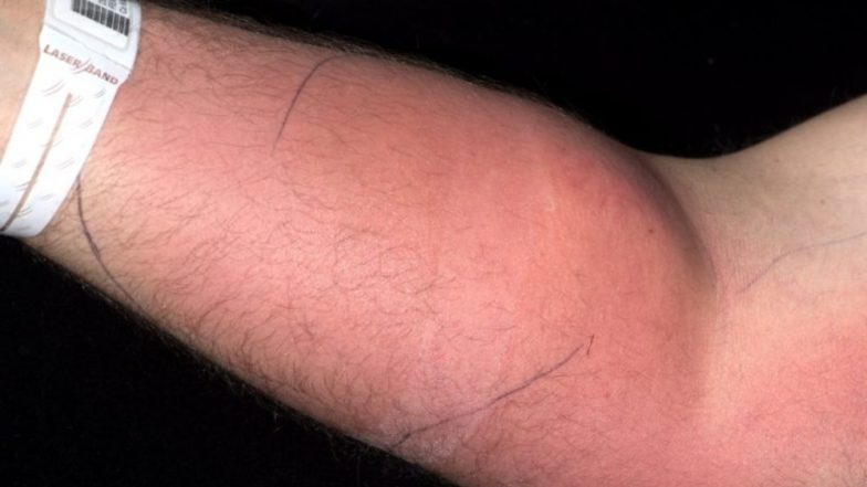 Semen Injected by Man Into His Arm For 18 Months to Treat Back Pain