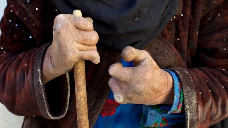 World Leprosy Day 2019: Will It Spread By Touching? 6 Myths About Leprosy You Should Stop Believing In World Leprosy Day 2019: Will It Spread By Touching? 6 Myths About Leprosy You Should Stop Believing In