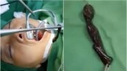 Woman Diagnosed With Throat Tumour; Doctors Shocked to Find Two-Inch-Long Leech Inside it (Watch Viral Video)