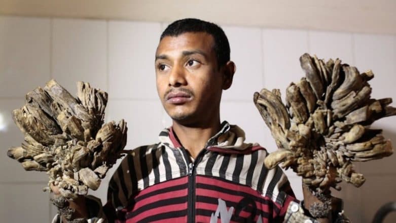 ‘Tree Man’ of Bangladesh Seeks Treatment as Disease Returns; What is Epidermodysplasia Verruciformis? ‘Tree Man’ of Bangladesh Seeks Treatment as Disease Returns; What is Epidermodysplasia Verruciformis?