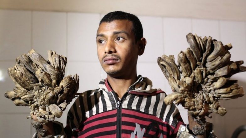 &lsquo;Tree Man&rsquo; of Bangladesh Seeks Treatment as Disease Returns; What is Epidermodysplasia Verruciformis?