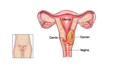 World Cancer Day 2019: What is Cervical Cancer and Why EVERY Woman Should Get Herself Screened