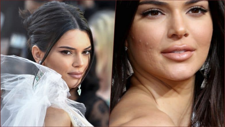 Let Me Live: Kendall Jenner Admits тАШCrying EndlesslyтАЩ on Being Shamed for Acne Let Me Live: Kendall Jenner Admits тАШCrying EndlesslyтАЩ on Being Shamed for Acne