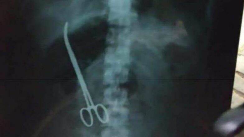 Doctors at NIMS Hyderabad Leave Scissor in a Woman's Abdomen Doctors at NIMS Hyderabad Leave Scissor in a Woman's Abdomen