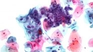 Cervical Cancer in India Could Be Eliminated by 2079 Says Lancet Study