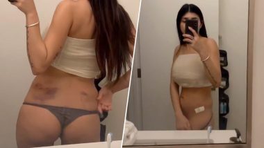 25 Years Old Xxx - Mia Khalifa, Former XXX Porn Star, Shares Glimpse of Her Recovery After Ice  Hockey Puck Deflated Her Boobs; View Pics | ðŸ LatestLY