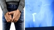 Shocking! Penis Shoved with 39 Magnet by a 12-year-old Schoolboy out of Curiosity; Left Him Unable to Pee