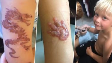 Boy Burnt By Black Henna Tattoo May Need Skin Grafting Surgery