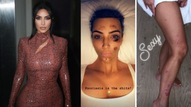 Kim Kardashian West Reveals She Has Psoriasis: 10 Natural Remedies to Treat the Skin Disease at Home!