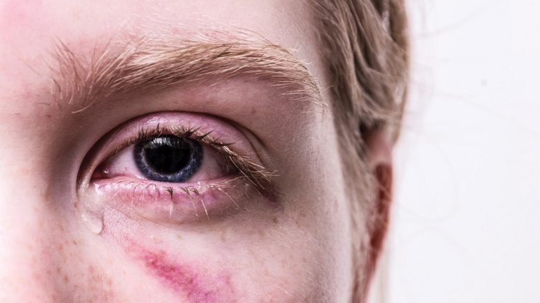 Eye Injury Can Now Be Fixed Without Surgery After American Scientists Invent Adhesive Gel