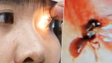 Doctors Remove 4 Bees From Taiwanese Woman's Eyes That Were Feeding on Her Tears, Watch Terrifying Video!