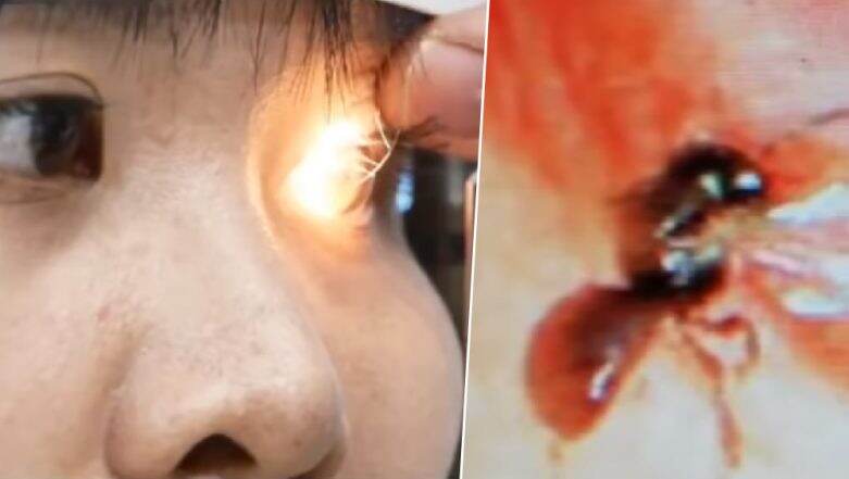Doctors Remove 4 Bees From Taiwanese Woman's Eyes That Were Feeding on Her Tears, Watch Terrifying Video! Doctors Remove 4 Bees From Taiwanese Woman's Eyes That Were Feeding on Her Tears, Watch Terrifying Video!
