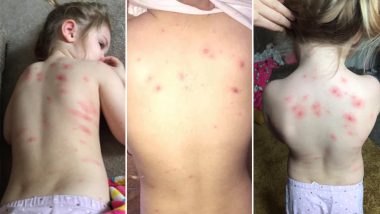 Chickenpox in Kids: UK Mom Has the Cheapest Trick to Get Rid of Chickenpox Rashes