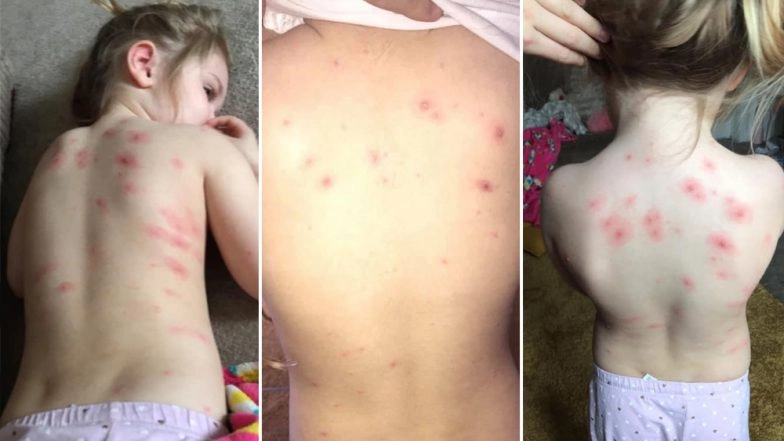 Chickenpox in Kids: UK Mom Has the Cheapest Trick to Get Rid of Chickenpox Rashes