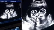 Foetal Rivalry? Twins Seen Fighting Inside Mom&rsquo;s Womb During Ultrasound Scan in China (Watch Viral Video)
