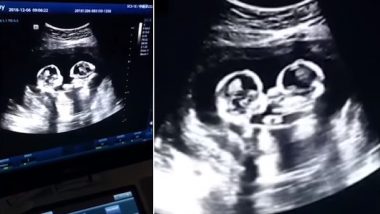 Foetal Rivalry? Twins Seen Fighting Inside Mom’s Womb During Ultrasound Scan in China (Watch Viral Video)