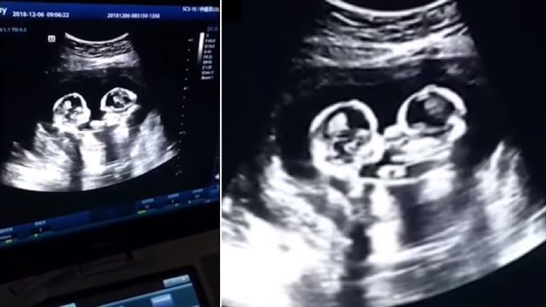 Foetal Rivalry Twins Seen Fighting Inside Moms Womb During Ultrasound Scan In China Watch 3500