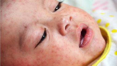 US Eliminated Measles in 2000, But Now Its Back With A Vengeance as Children Miss Vaccination Doses
