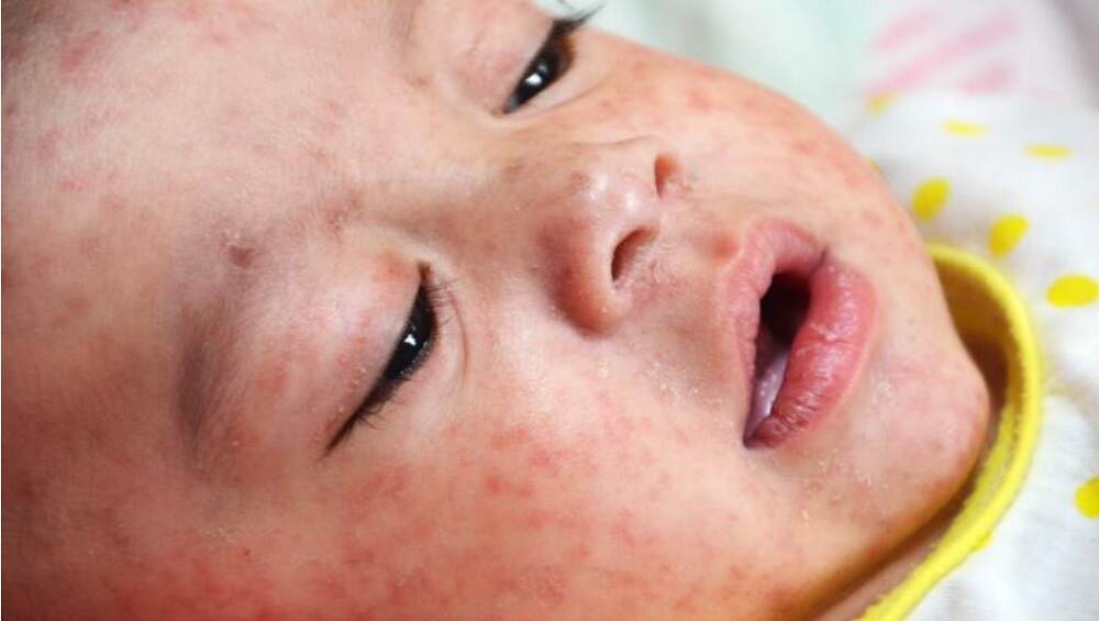 DR Congo Measles Outbreak Kills 6,000 in a Year: WHO DR Congo Measles Outbreak Kills 6,000 in a Year: WHO