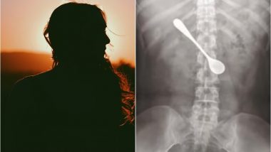 Chinese Woman Swallows 13-Cm-Long Metal Spoon to Get Rid of Fish Bone Stuck in Throat, Rushed to the Hospital