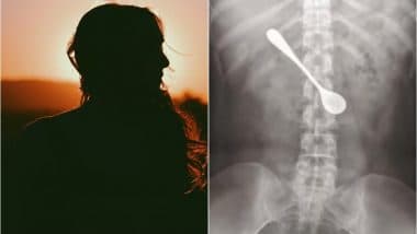 Chinese Woman Swallows 13-Cm-Long Metal Spoon to Get Rid of Fish Bone Stuck in Throat, Rushed to the Hospital