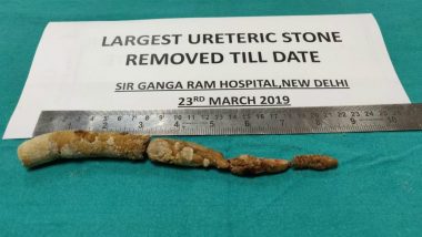 World 'Largest' Ureteric Stone Removed by Surgery in Delhi's Sir Ganga Ram Hospital