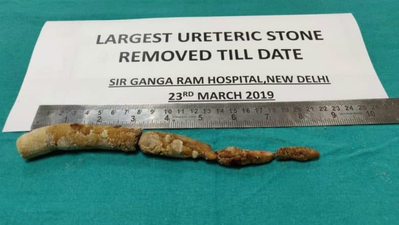 World 'Largest' Ureteric Stone Removed by Surgery in Delhi's Sir Ganga Ram Hospital World 'Largest' Ureteric Stone Removed by Surgery in Delhi's Sir Ganga Ram Hospital