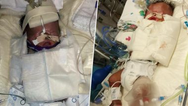 Miracle Baby! Premature Child Born Without Any Skin Survives After Grafting Surgery in Texas
