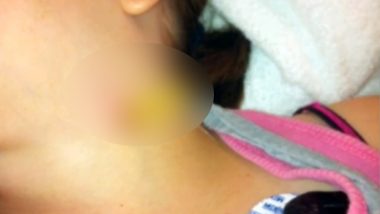 11-Year-Old Gets Pencil Stuck in Her Neck After She Fell on it While Playing at School in Toronto (Watch Shocking Video)