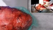Indian Man With &lsquo;World&rsquo;s Largest Brain Tumour&rsquo; Let It Grow Because He Was Scared of Surgery: How to Check If Your Tumour Is Cancerous or Benign