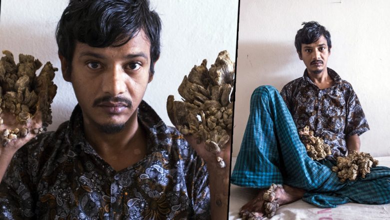 Bangladeshi 'Tree Man' Abul Bajandar Wants Hands Amputated to Relieve ...