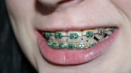 Braces Won&rsquo;t Guarantee Happiness, Self-Confidence