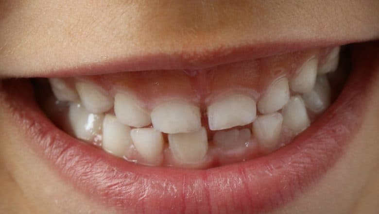 Poor Oral Health Increases Risk of Liver Cancer Poor Oral Health Increases Risk of Liver Cancer