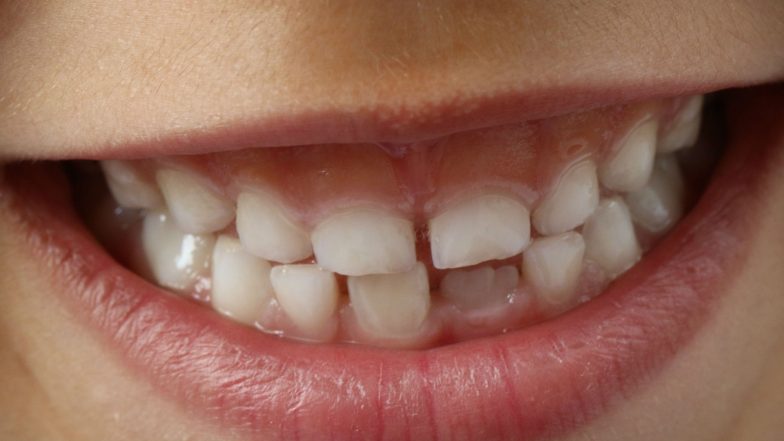 Doctors Extract 526 Teeth From 7-Year-Old Boy’s Mouth at Saveetha Dental College and Hospital in Chennai