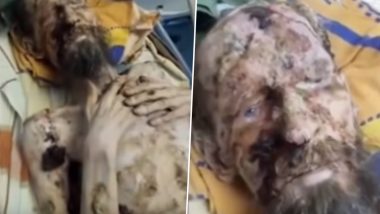 ‘Living Mummy’ Was Never Attacked by Bear and Kept in Den, Doctor Reveals the Truth Behind Fake Viral Video