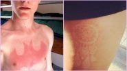 &lsquo;Sunburn Tattoos&rsquo; Are the Latest Trend on Social Media & We Are Not Talking About Tan Lines Here (See Viral Pics)