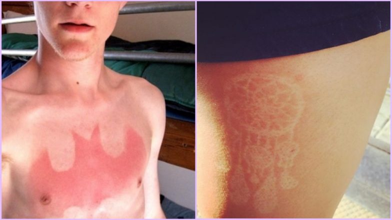 ‘Sunburn Tattoos’ Are the Latest Trend on Social Media & We Are Not Talking About Tan Lines Here (See Viral Pics)